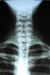 X-ray of spine